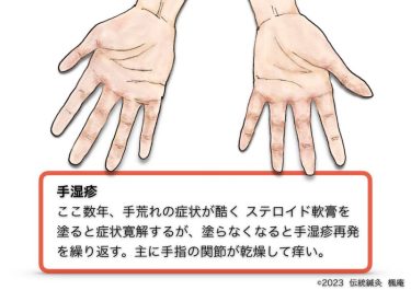 【治療日誌】手湿疹(3) No.1