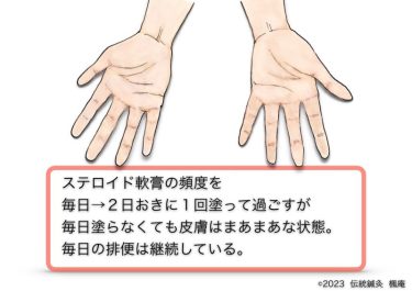 【治療日誌】手湿疹(3) No.3