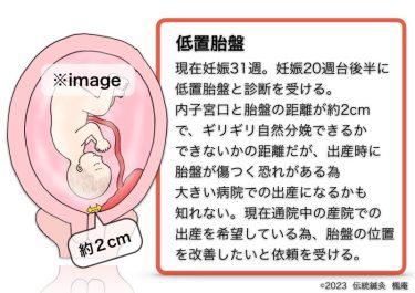 【治療日誌】低置胎盤(2) No.1