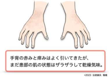 【治療日誌】手湿疹(4) No.2