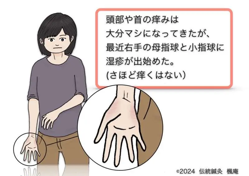 治療日誌】アトピー性皮膚炎(18) No.3｜伝統鍼灸 楓庵