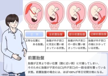 【症例】前置胎盤・低置胎盤