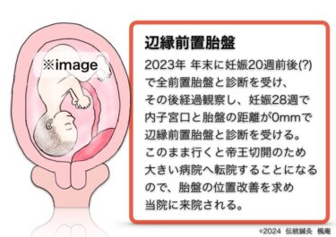 【症例集】辺縁前置胎盤(10)