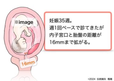 【治療日誌】辺縁前置胎盤(10) No.2