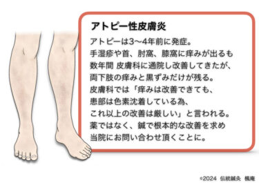 【治療日誌】アトピー性皮膚炎(19)