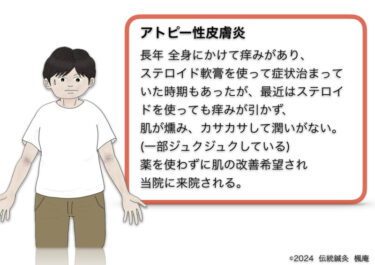 【治療日誌】アトピー性皮膚炎(20)