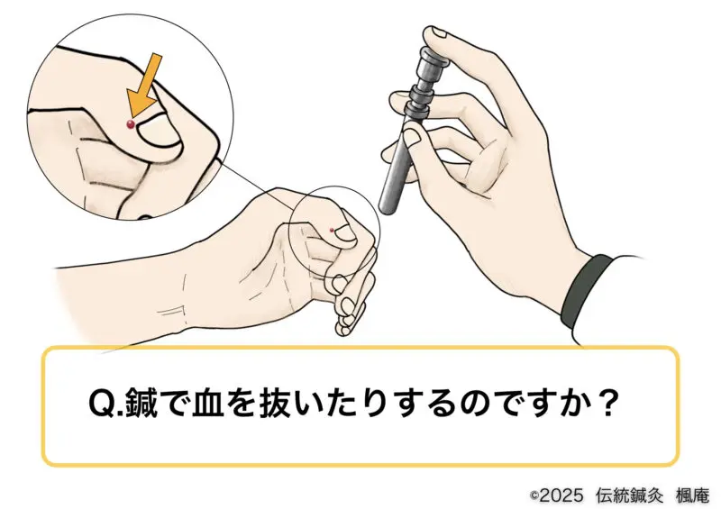 Q&A】鍼で血を抜いたりするのですか？｜伝統鍼灸 楓庵