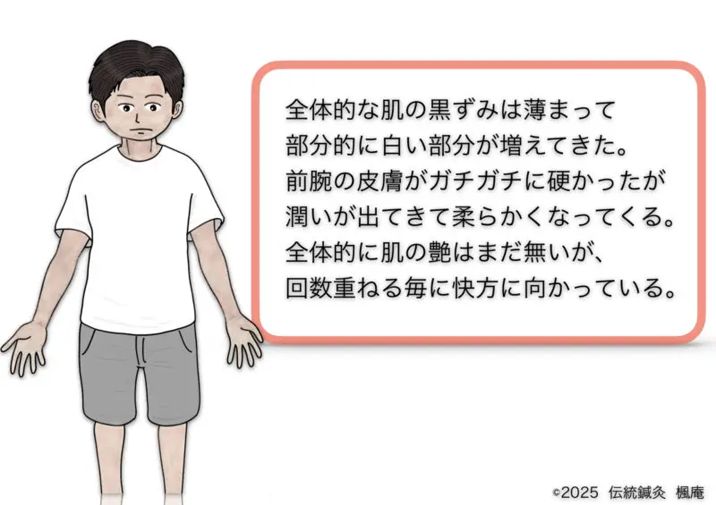 アトピー性皮膚炎