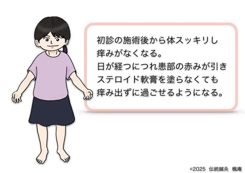 アトピー性皮膚炎