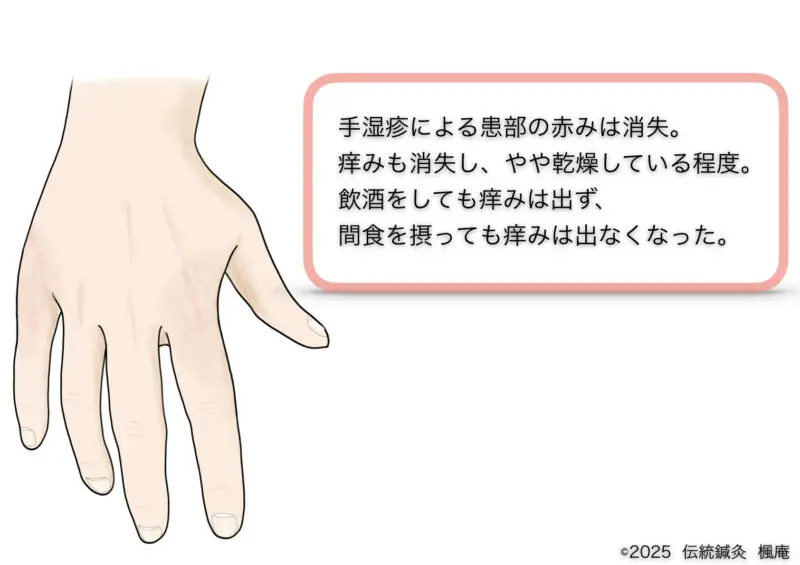 手湿疹