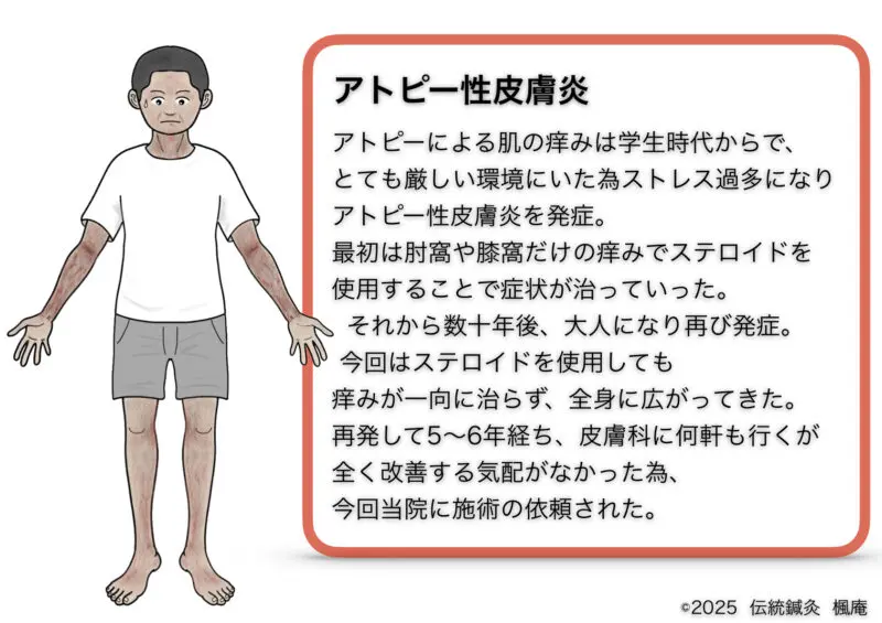 アトピー性皮膚炎