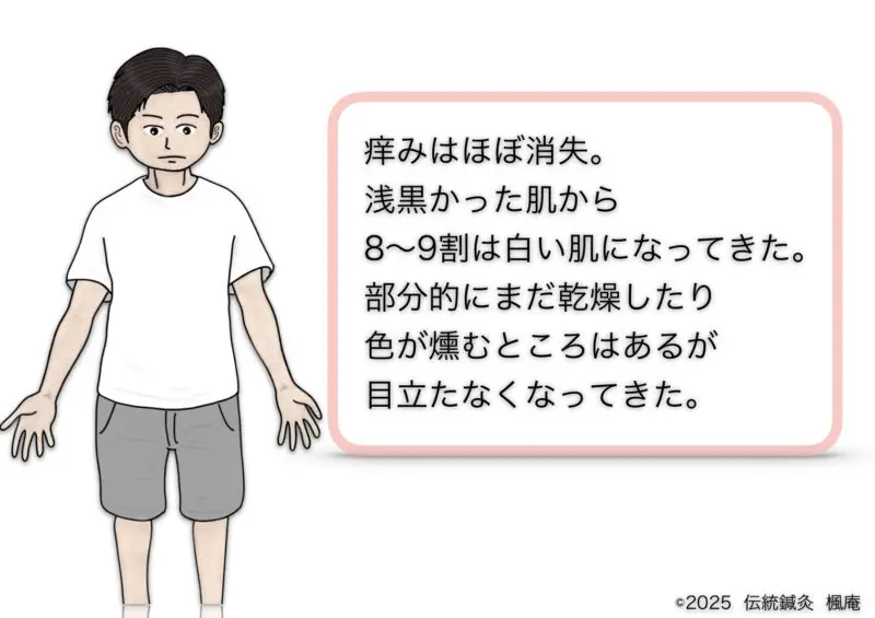 アトピー性皮膚炎