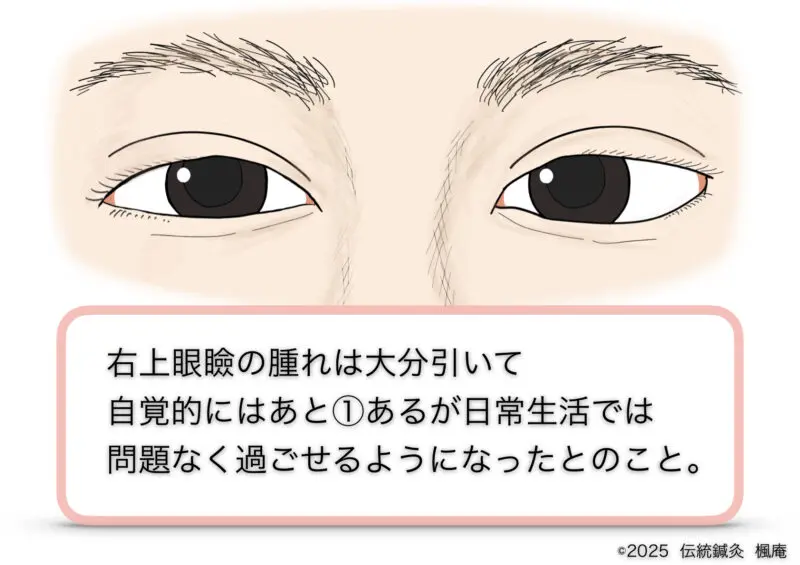 霰粒腫