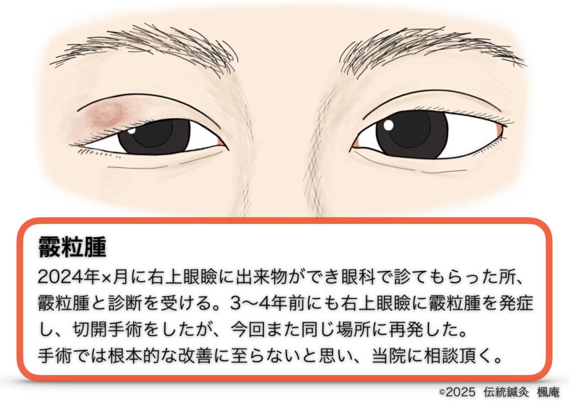 【治療日誌】霰粒腫(1)