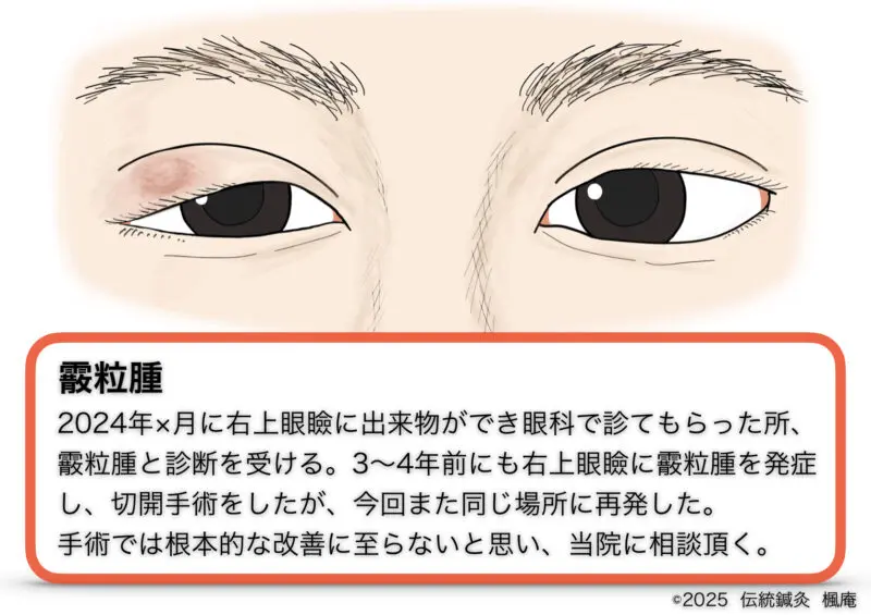 霰粒腫