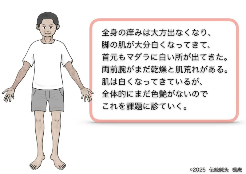 アトピー性皮膚炎