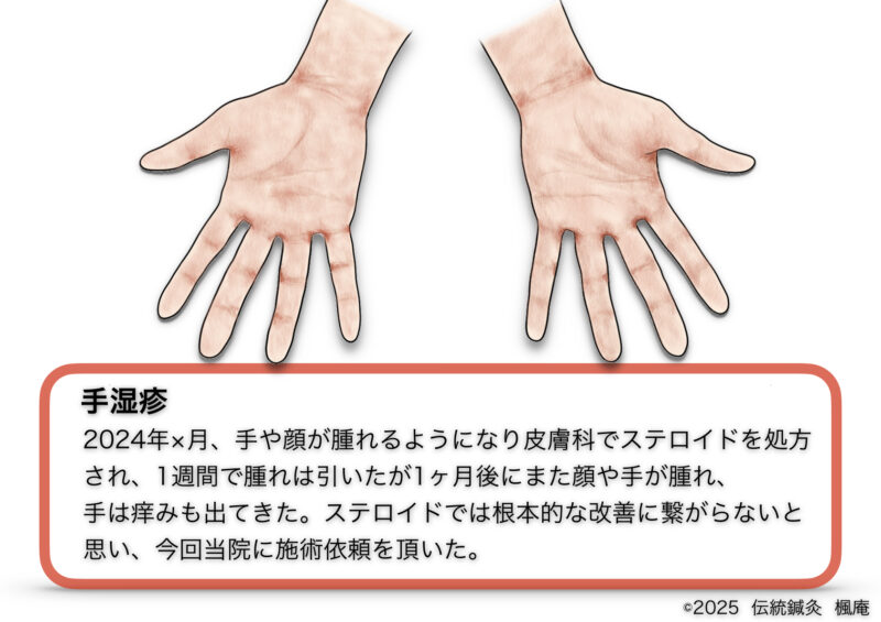 【治療日誌】手湿疹(7)