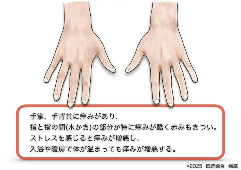 手湿疹