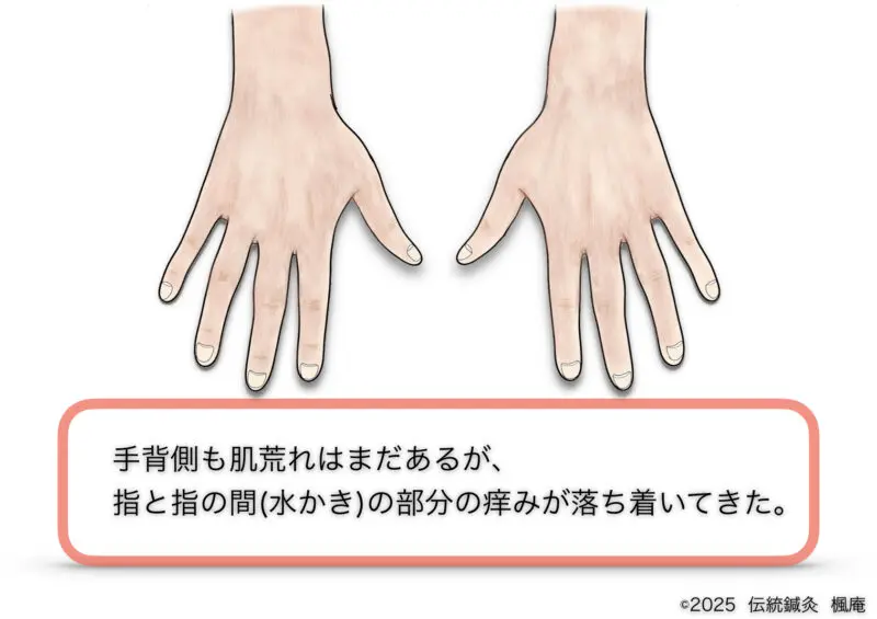 手湿疹