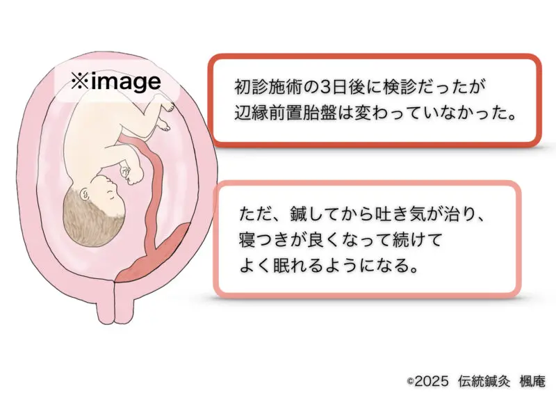 辺縁前置胎盤