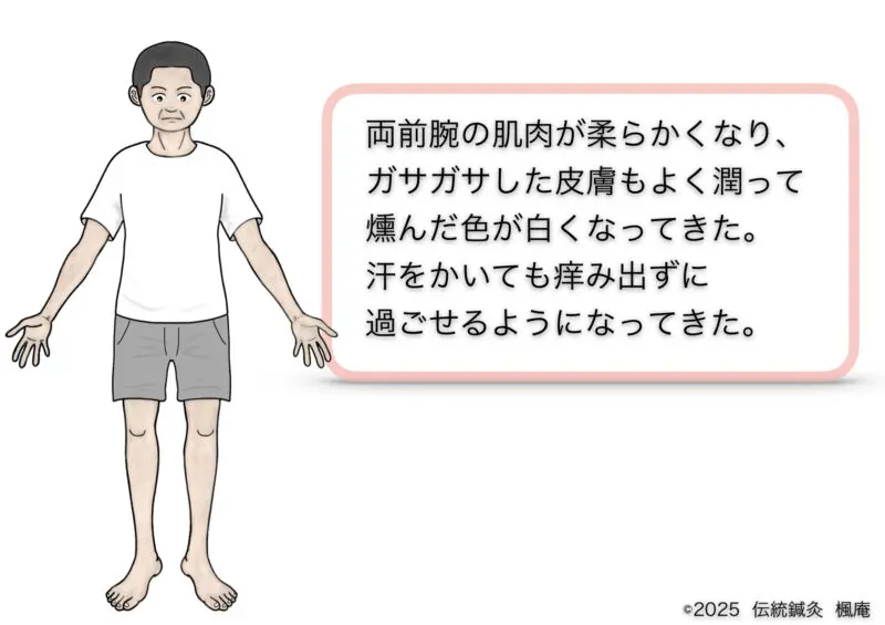 アトピー性皮膚炎
