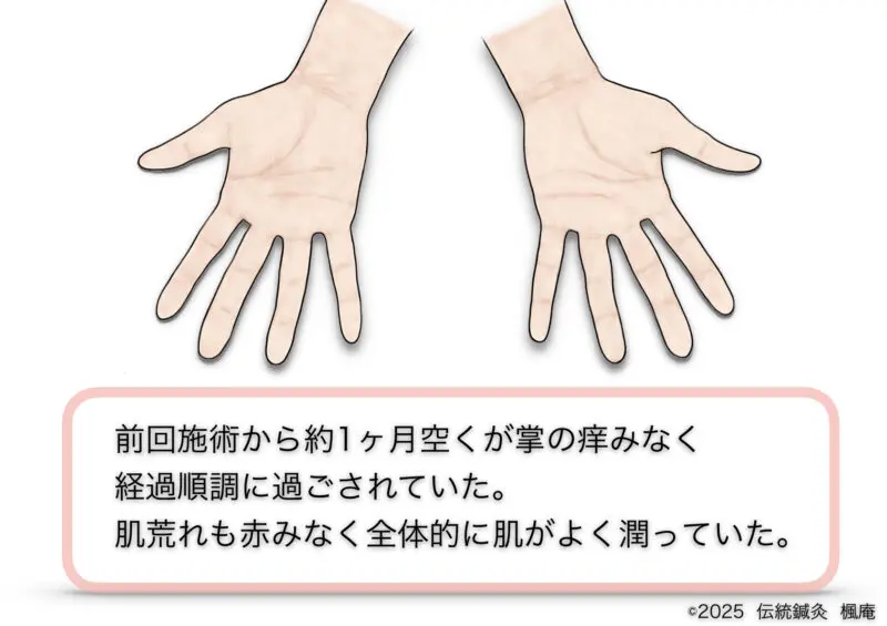 手湿疹