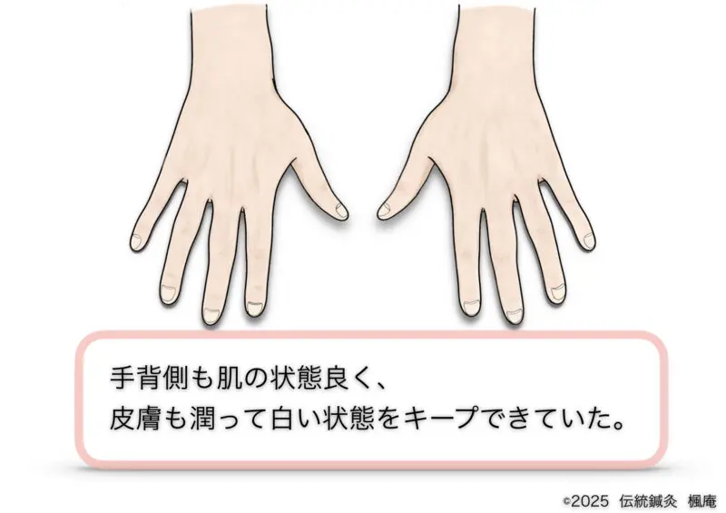 手湿疹