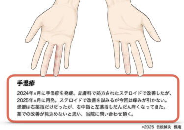 手湿疹