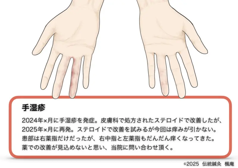 手湿疹