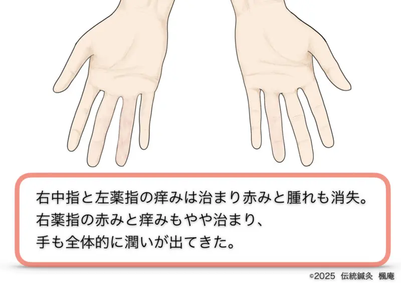 手湿疹