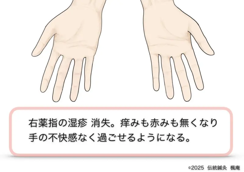 手湿疹