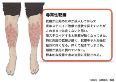 尋常性乾癬
