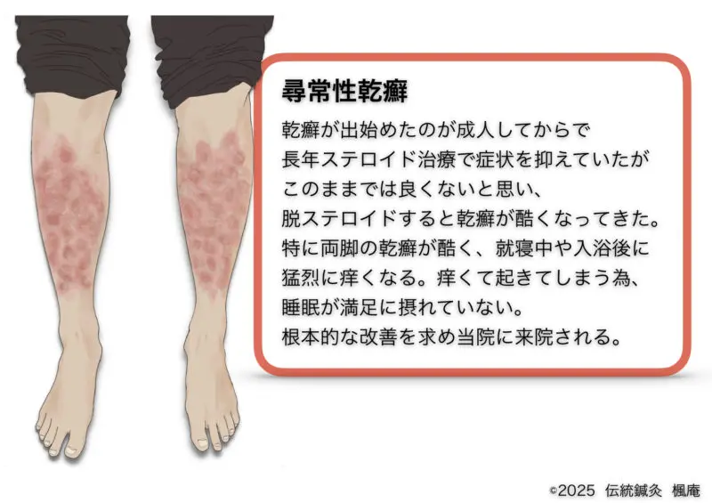 尋常性乾癬