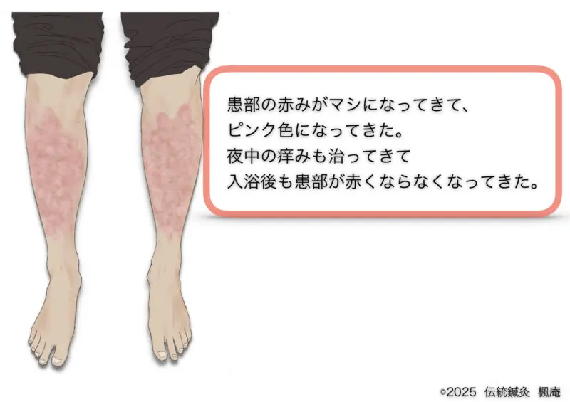 尋常性乾癬
