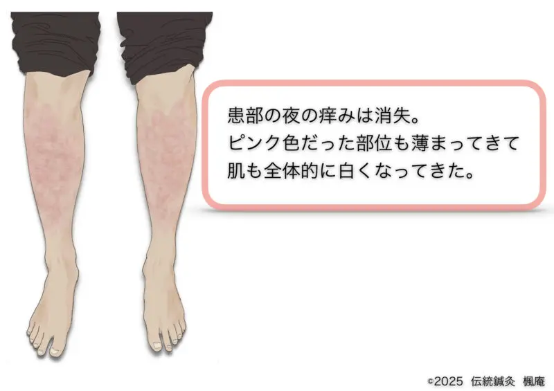 尋常性乾癬