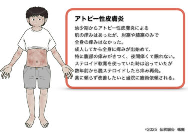 【治療日誌】アトピー性皮膚炎(25)