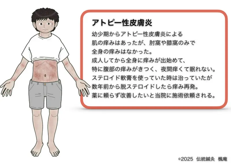 アトピー性皮膚炎