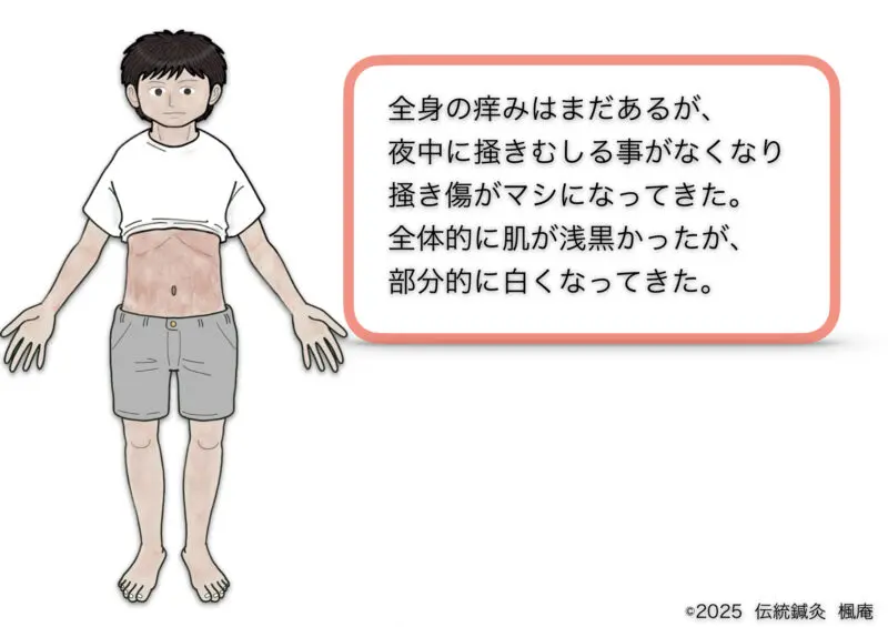 アトピー性皮膚炎