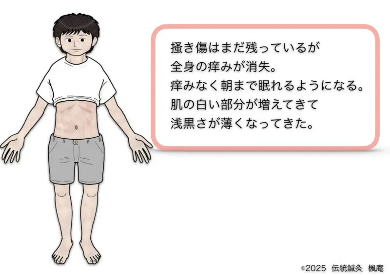 アトピー性皮膚炎