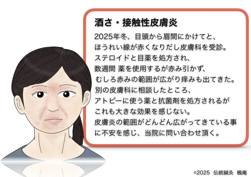 酒さ・接触性皮膚炎