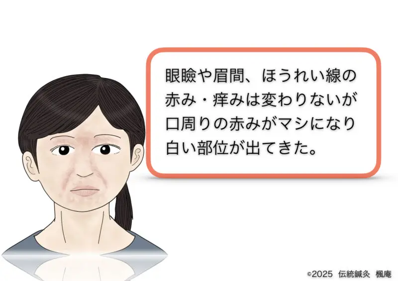 酒さ・接触性皮膚炎