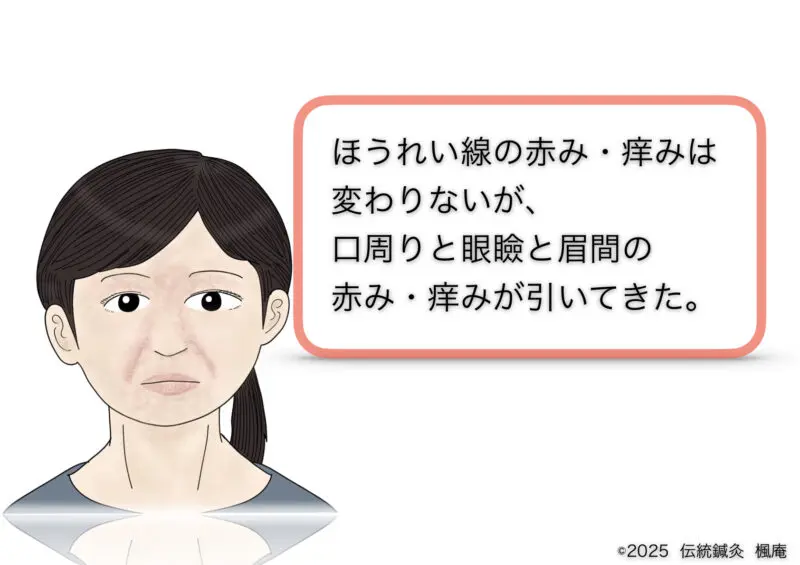 酒さ・接触性皮膚炎