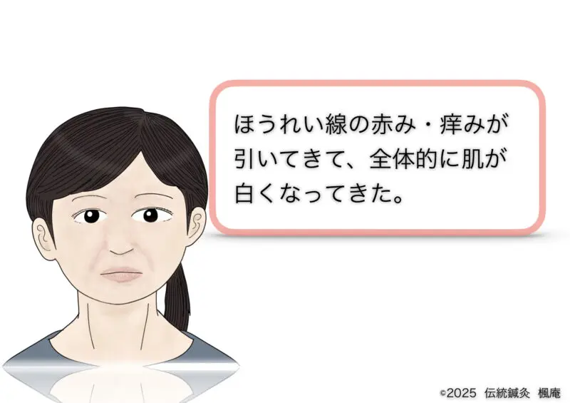 酒さ・接触性皮膚炎