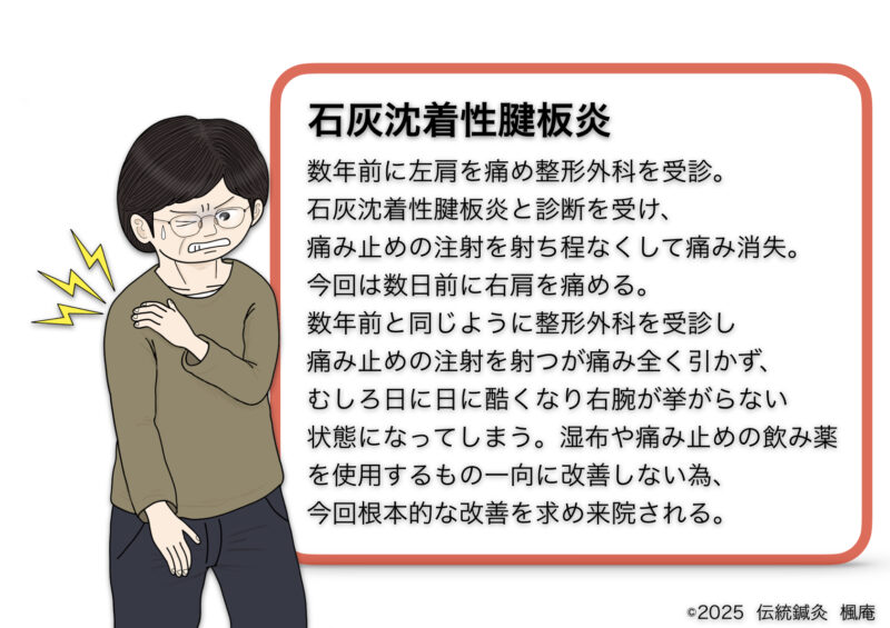 石灰沈着性腱板炎