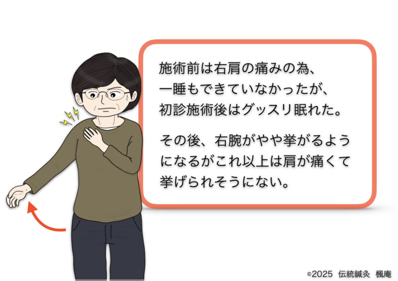 石灰沈着性腱板炎