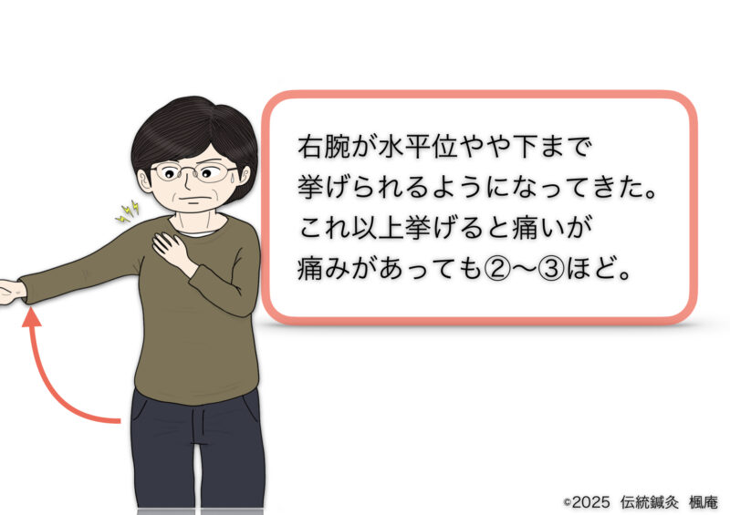 石灰沈着性腱板炎