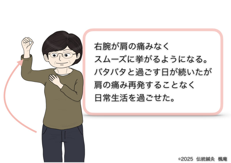 石灰沈着性腱板炎