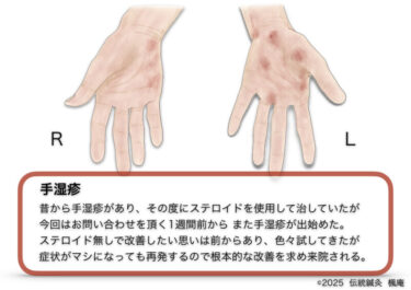手湿疹