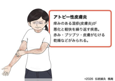 アトピー性皮膚炎