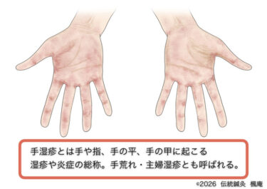 手湿疹